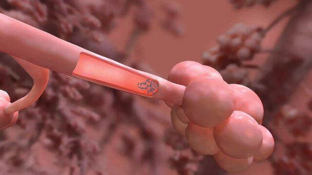 COPD, Chronic bronchitis