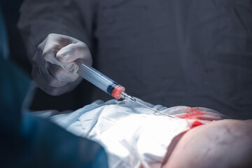 Plastic surgery to eliminate consequences of breast cancer, surgeon holds syringe with patient fat