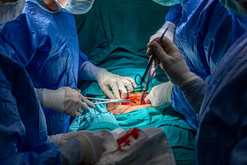 Surgeons performing cesarean section in operating room. Birth surgery with Caesarean. New life,...