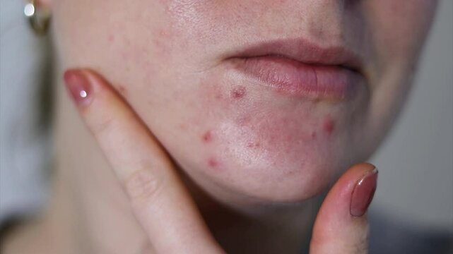 Close up of female face with red problematic acne skin, blurry background 