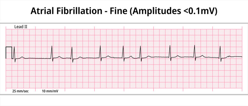 Fine Atrial Fibrillation - 8 Second ECG Paper - Electrocardiography Vector Medical Illustration