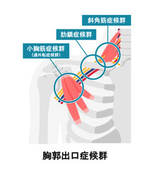 胸郭出口症候群の発生する部位 ベクターイラスト