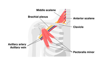 Vector illustration of where thoracic outlet syndrome occurs