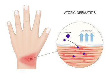 Eczema. Atopic dermatitis vector. Close-up of human skin with dermatitis. Penetration of allergens causes skin allergies. 
