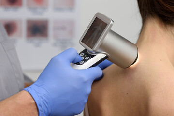 Digital dermatoscopy of moles. A dermatologist-oncologist examines the patient's moles using a...