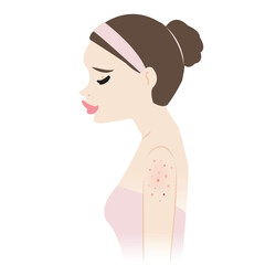 The woman with acne on upper arms vector illustration isolated on white background. Acne, pimples, blackheads, comedones, whiteheads, papule, pustule, nodule and cyst on arm. Skin problem concept.