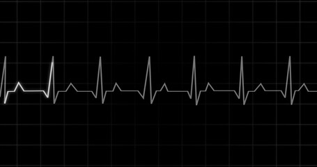 EKG Heartbeat reading animation on black background. Medical monitor displaying cardiography pulse checkup diagnosis electronic screen display machine. Cardiogram nubes rate ecg waveform surgery.