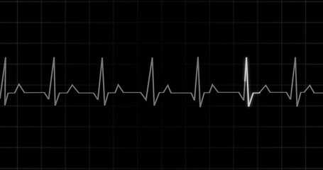 EKG Heartbeat reading animation on black background. Medical monitor displaying cardiography pulse checkup diagnosis electronic screen display machine. Cardiogram nubes rate ecg waveform surgery.