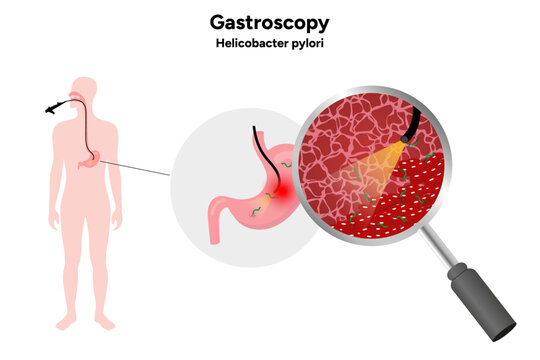 Gastroscopy procedure, helicobacter pylori