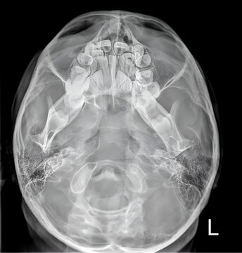 Human skull SMV digital radiograph 