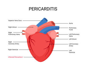 Diagram of human heart with pericarditis disease