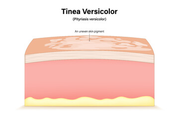 Tinea versicolor. Pityriasis versicolor. Fungal skin infection. Cross section of a human skin with Malassezia grows rapidly on the surface of the skin.