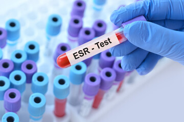 Doctor holding a test blood sample tube with ESR test on the background of medical test tubes with...