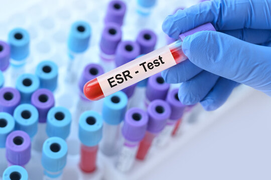 Doctor holding a test blood sample tube with ESR test on the background of medical test tubes with analyzes.
