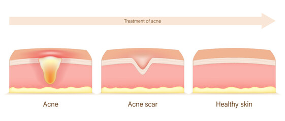 Treatment of acne vector. Acne, acne scar and healthy skin. Structure of the skin with acne treatment.