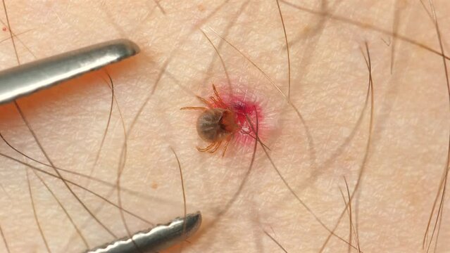 Close-up of tick embedded in human skin being removed with tweezers, highlighting importance of prompt parasite removal for disease prevention. Safety and health care.