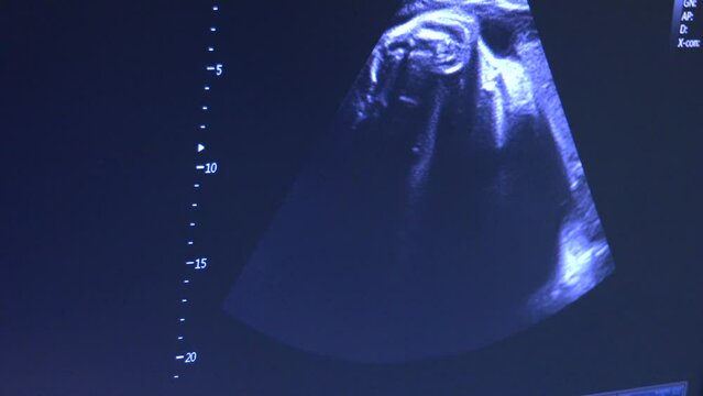 Ultrasound of baby in mother's womb.The images from a 2d ultrasound tend to be in black and white. Film Ultrasound (US) whole abdomen of a 40 years old female patient scan of stomach in hospital.
