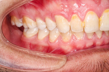 aesthetics, arches, beard, bite, cheek, cheek retractor, cheek retractors, cheeks, close-up, condition, conditions, dental, dental clinic, dental photography, denture, gingiva, hair, health, health ca © MSC