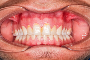 Frontal view of dental maxillary and mandibular arches in occlusion with biting yellowish teeth well aligned, cheeks and lips retracted with cheek retractor. Healthy gingival gum and no decay. © MSC