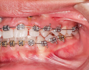 Lateral and front view of dental arches in biting teeth occlusion, orthodontic braces, elastic O-ring ligature and arch wire. Mini-implants in hyperplasic gingival gum, hyperplasia or hypertrophy. © MSC