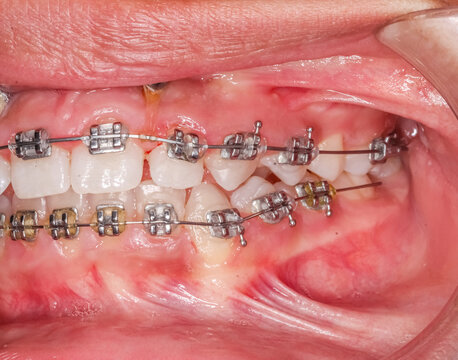 Lateral and front view of dental arches in biting teeth occlusion, orthodontic braces, elastic O-ring ligature and arch wire. Mini-implants in hyperplasic gingival gum, hyperplasia or hypertrophy.