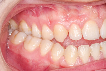 Lateral oblique view of dental maxillary and mandibular arches in occlusion with crooked teeth in...