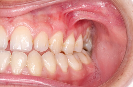 Lateral oblique view of dental maxillary and mandibular arches in occlusion with crooked teeth in articulated cross and open bite, cheeks and lips retracted with cheek retractor. Healthy gingival gum.