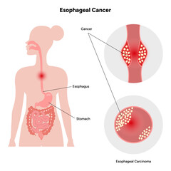 Esophageal cancer
