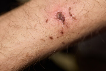 A closeup of a bruised arm with a temporary tattoo