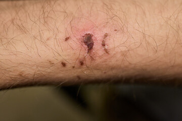 A closeup of a bruised arm with a temporary tattoo