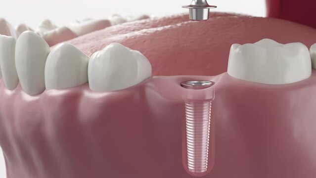 Closeup white tooth and gum with Dental implant , Human Teeth for Medical Concept.