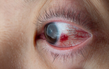 Red eyes with blood vessels in the eyes.
