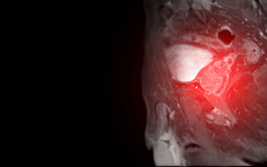 MRI of the prostate gland, revealing an enlarged size.