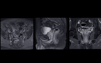 MRI of the prostate gland, revealing an enlarged size.