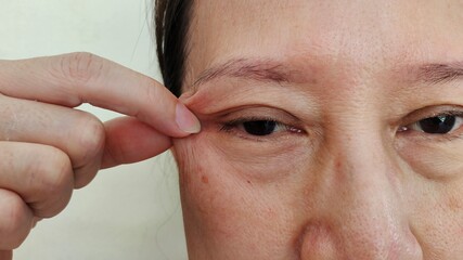 Portrait the fingers holding the flabbiness adipose sagging skin, ptosis and loose beside the eyelid, swelling and Flabby skin under the eyes, dark spots and blemish on the face of the woman.