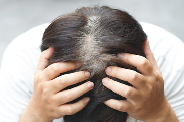 Top view of young people premature gray hair, showing black hoary hair roots on head change to...
