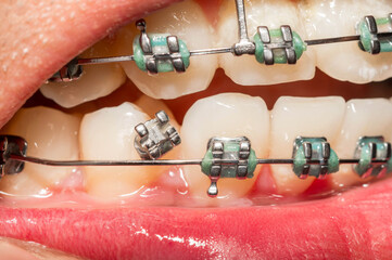 broken braces or wire breaks missing