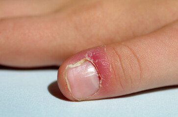 Skin disease. Lichen, psoriasis and skin diseases