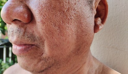 Obraz premium Portrait showing the wrinkle and Flabby skin, rash and allergy, blackhead and acne, hives and reaction, dark spots and blemish, freckles and loose on the Face, health care and medical concept.