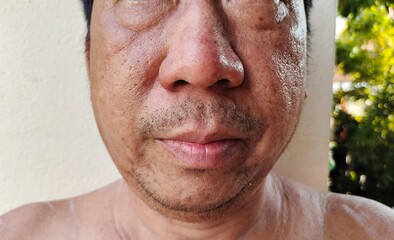 Portrait showing the wrinkle and Flabby skin, rash and allergy, blackhead and acne, hives and...