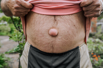 An adult elderly man shows a large umbilical hernia on his abdomen. Photography, disease concept.