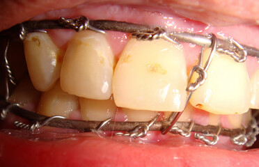 Metal plate of the upper jaw and lower sled after surgical intervention of deformation of the facial bones © tonysk