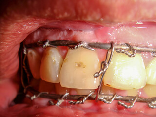 Metal plate of the upper jaw and lower sled after surgical intervention of deformation of the facial bones © tonysk
