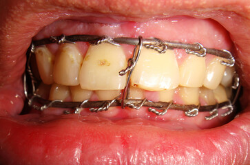Metal plate of the upper jaw and lower sled after surgical intervention of deformation of the facial bones © tonysk