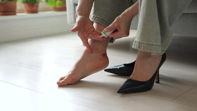 Female hands gently treating callus on foot, smearing wound with healing ointment. Corns on ankles caused by wearing tight discomfortable shoes footwear during workday. Acute painful injuries on leg.