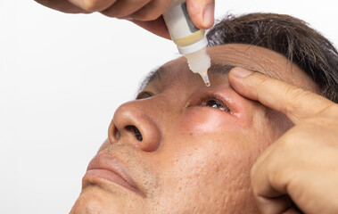 Senior man use antibiotic eye drops to treat swollen eye from insect bite.