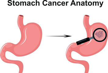 Stomach Cancer Anatomy Science Diagram vector illustration