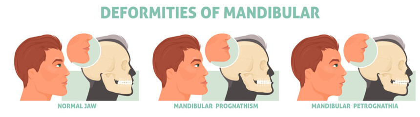 Deformities of mandibular with normal jaw, prognathism and petrognathia symptom medical poster vector illustration. Cranio defects, facial cosmetic disorder © Siberian Art