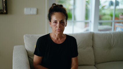 Middle age hispanic woman suffering for domestic violence with bruise on eyes at home