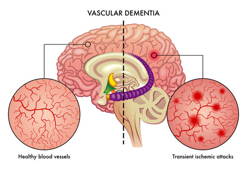 Medical illustration compares healthy blood vessels of the brain, with others affected by transient ischemic attacks which are one of the causes of vascular dementia in the brain.